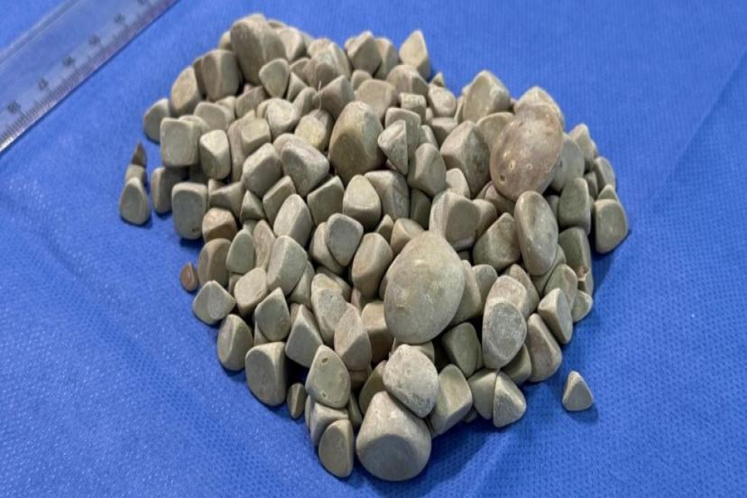 VÜCUDUNDAN 287 TANE TAŞ ÇIKARILDI